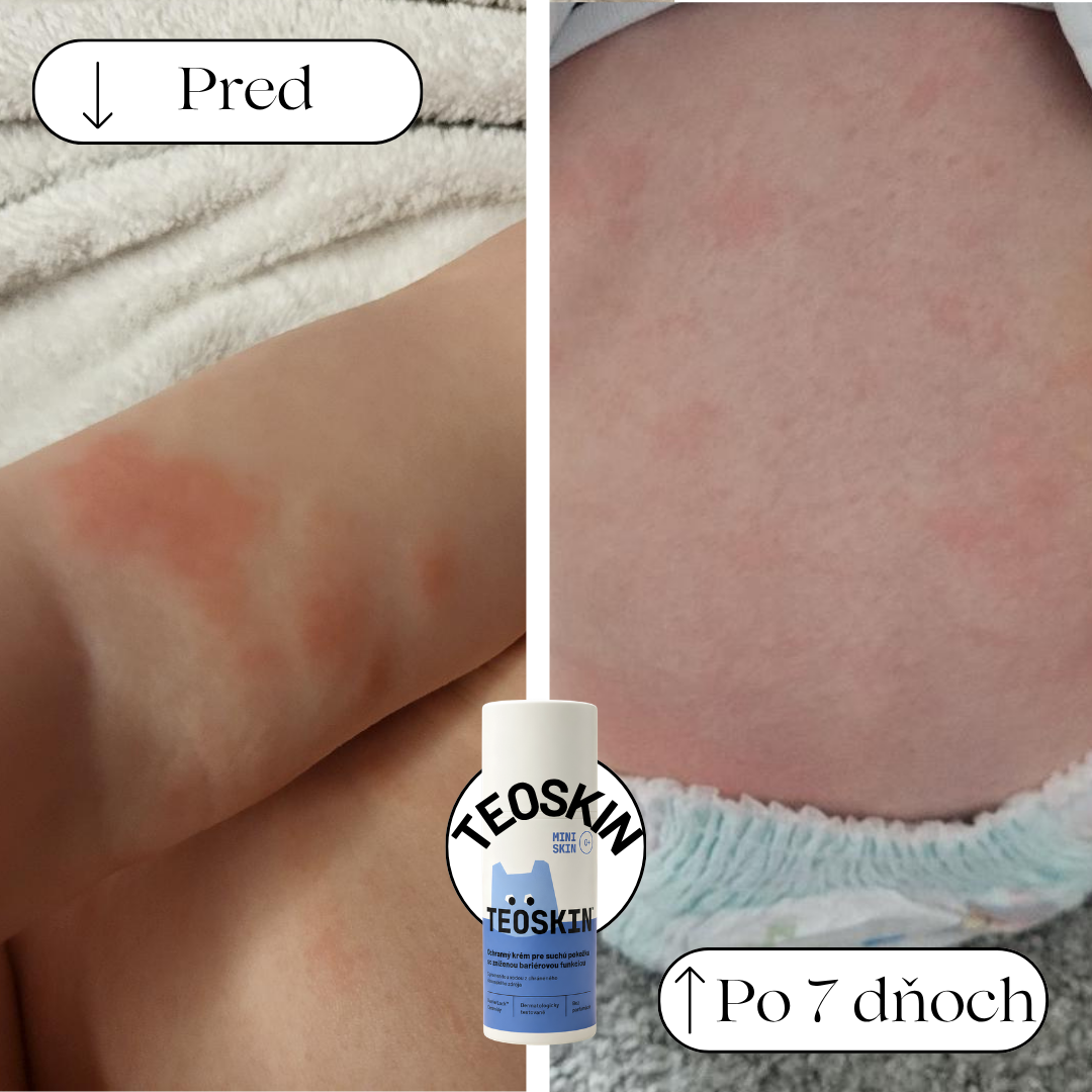 Výsledky pred a po Jana G. (10-mesačné bábätko) - Ochranný krém TEOSKIN